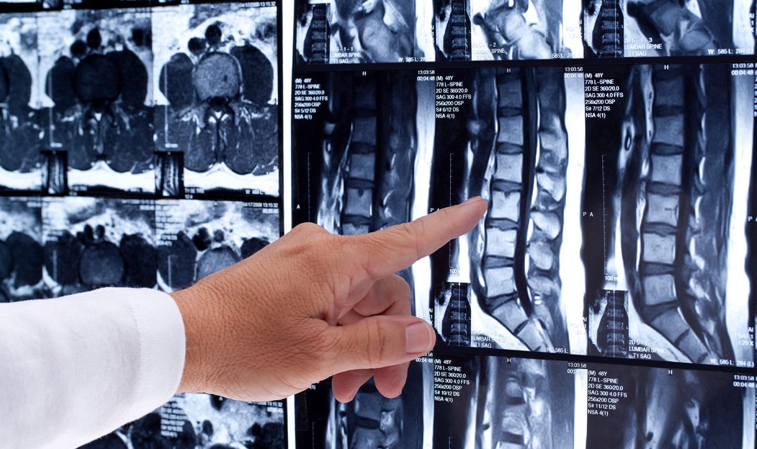 Choosing the Right Specialist for Spine Surgery: Finding Your Ideal Doctor